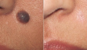 SPECIALISED CARE: Scarless Mole Removal